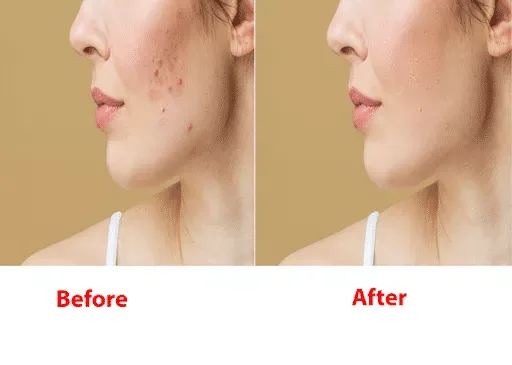 Skin retouching